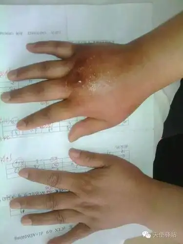 静脉输液时药物外渗的预防及处理,你都了解吗?_手机搜狐网