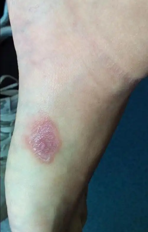 男的得了一期梅毒图片