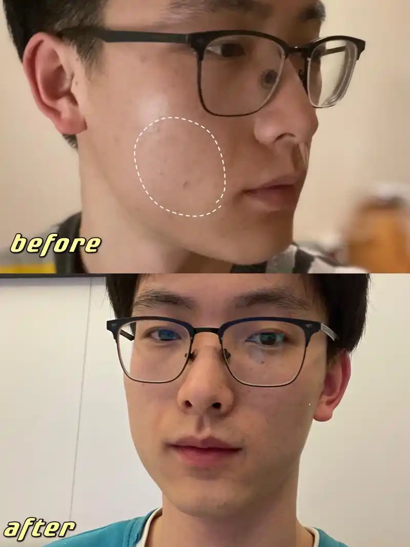 光子嫩肤多久做一次?