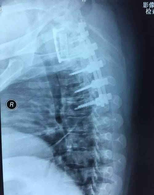 经验分享颈椎,胸椎骨折虽然只是常规手术,但患者受伤部位于颈胸节段