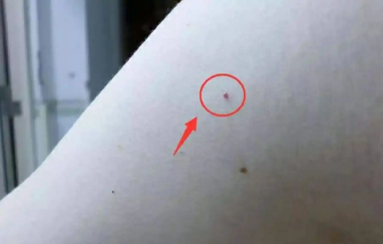 朱砂痣代表什么意思?长朱砂痣好不好?