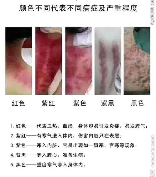 刮痧多久刮一次比较好拔罐和刮痧哪个去湿气