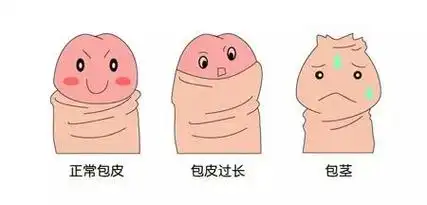 包皮过长,包茎的危害胡主任介绍,很多孩子是像小涛这种,年龄5岁以上