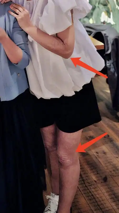 selina平日里不爱穿裤子,即便是烧伤之后也依然穿裙子居多,把自己打扮