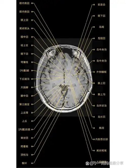 颅脑mr解剖-第三脑室