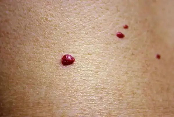 1,毛细血管型血管瘤