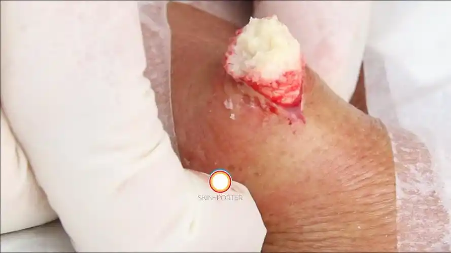 轻度感染粉瘤微创切除术 高清 hd high definition 1080