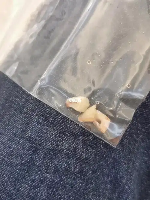 埋伏虎牙拔除记录_美妆_医美_整容_美妆_医美整形