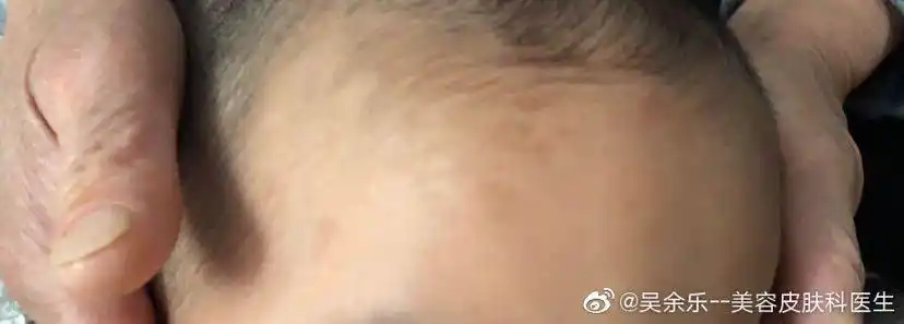 吴医生孩子的额头是鲜红斑痣吗