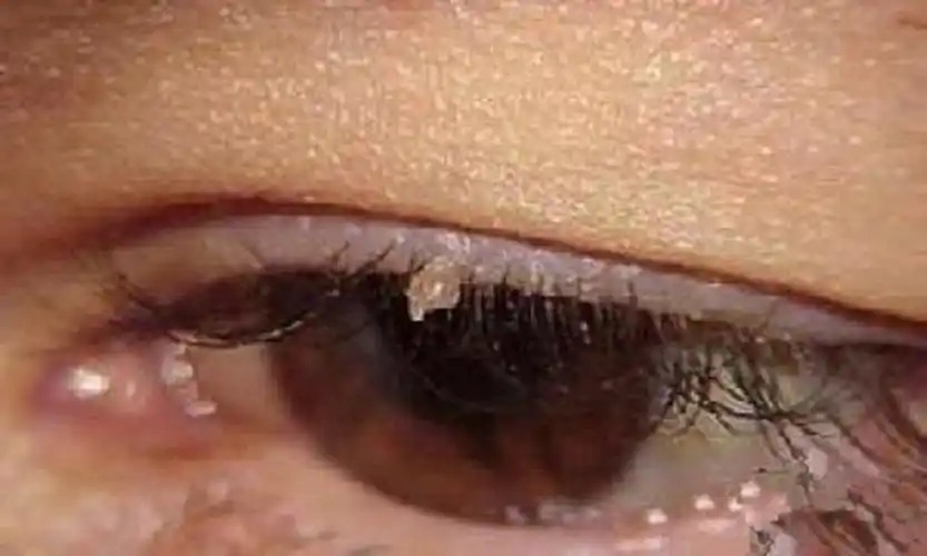 女肉芽状尖锐湿疣图_有来医生