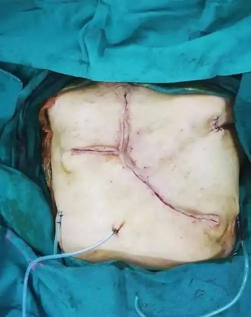 多学科密切合作顺利完成局部晚期乳腺癌手术