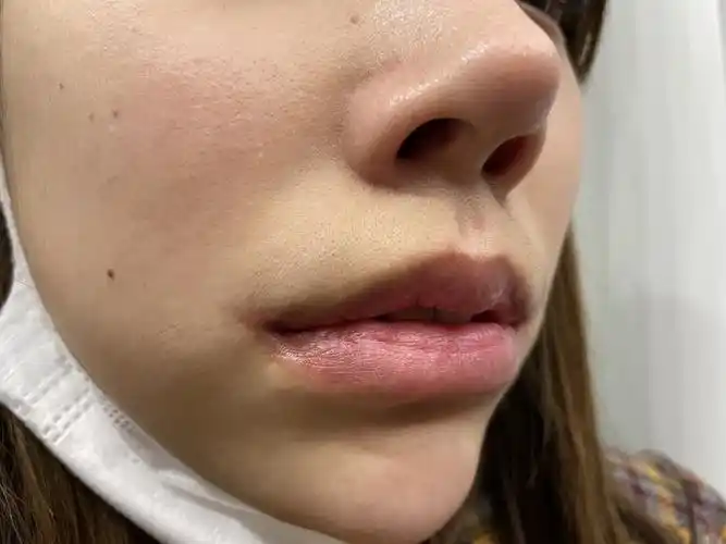 m唇术后两个月瘢痕增生求解