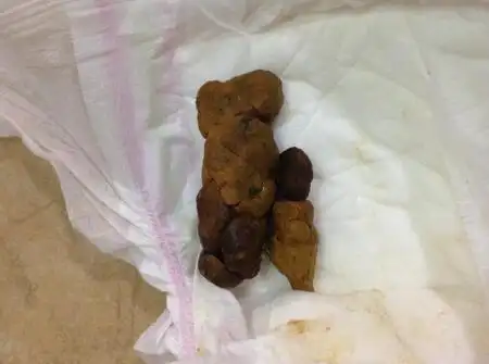 鲜红色大便表明宝宝的肛门周围有轻度撕裂伤或肛裂,是由于挤压导致