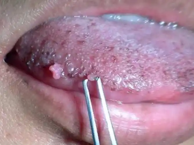 假尖锐湿疣白醋测试图片_有来医生