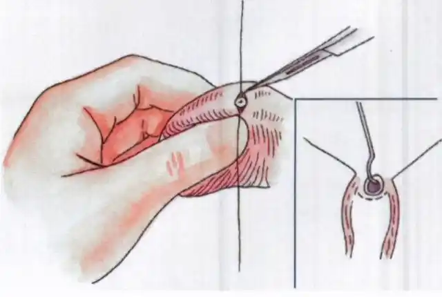 曾经盛极一时的男性结扎术如今为何淡出江湖医生道出真相