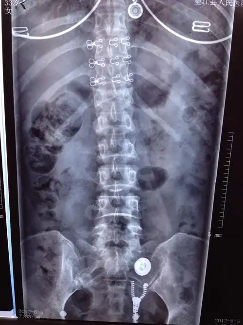 t12椎体爆裂性骨折伴不全瘫,没有减压,看效果