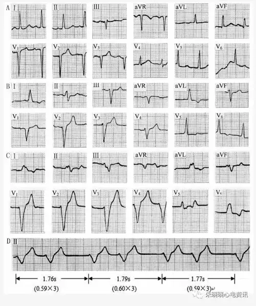 高钾血症临床关注的心电图问题