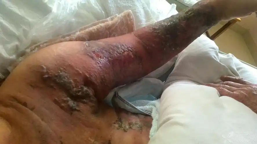 【求助】乳腺癌术后放疗后左上肢象皮肿怎么办?