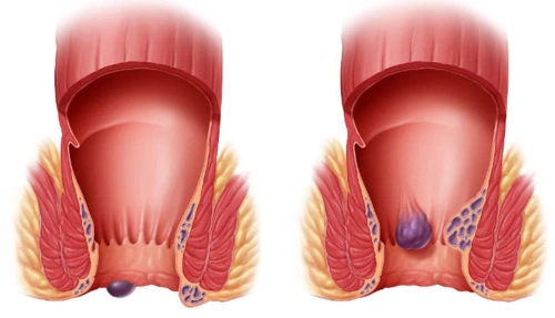 肛周息肉状突起图片8