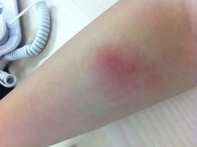 问:胳膊红肿痒一周抹药不好使