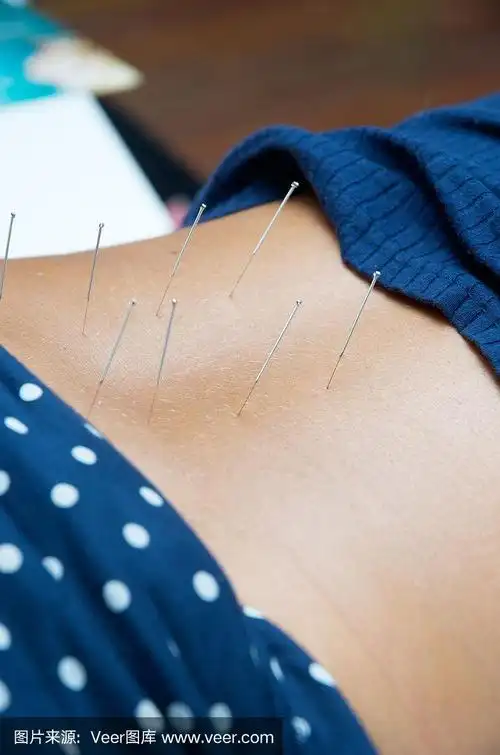 背部针灸
