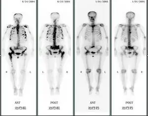 petct拍摄图片案例: 89锶 云克治疗多发骨转移疗效评价女性,52岁,乳腺