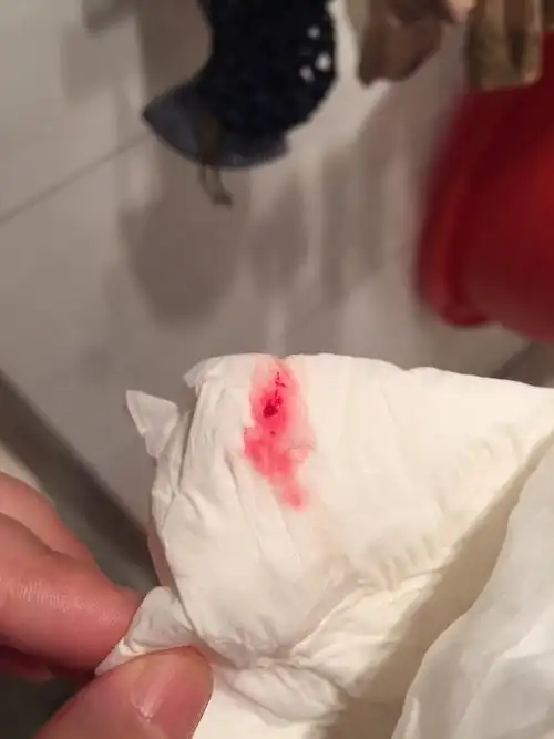 我今天上厕所时,尿液里出现了一个血片