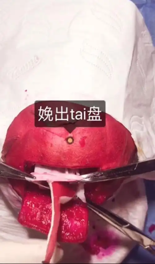 清理呼吸道第八步胎头用手托出第七步看到胎儿露头第六步刺破羊囊膜