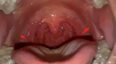 扁桃体位于人的口腔中,在口咽两侧,腭舌弓和腭咽弓之间的三角形间隙内