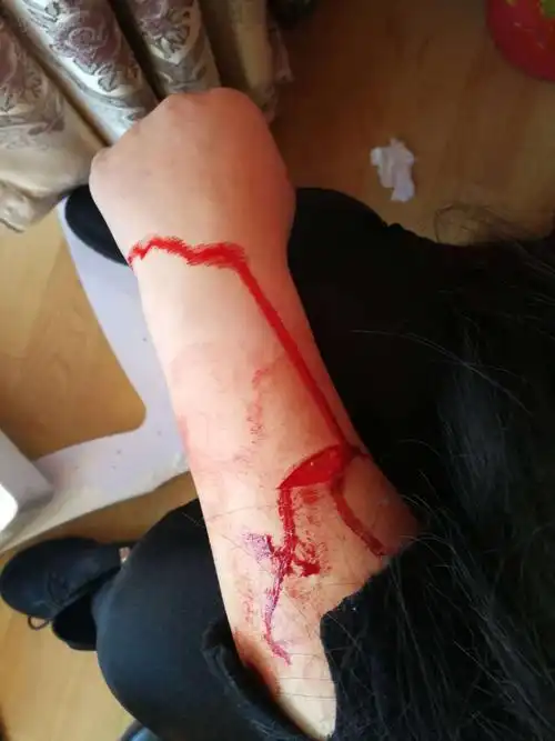 女子为赌气用眉刀割伤手臂 民警耐心劝服将其送医救治