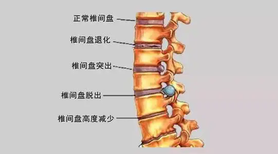腰间盘突出平躺治疗正确躺法一个动作十天治好腰椎病