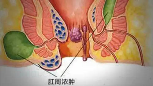 长沙治疗肛周脓肿好的医院肛周脓肿吃消炎药可以吗