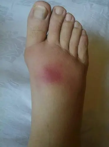 有谁知道这脚面红肿是什么原因啊?有糖尿病和肾病史.