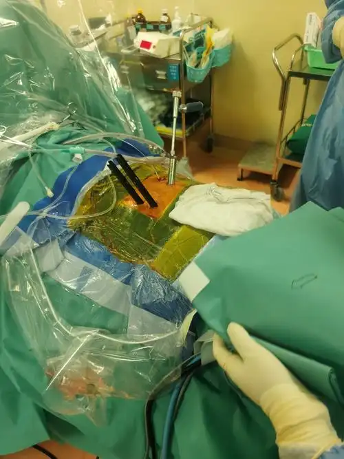 伍韵 腰5骶1滑脱 右侧椎间盘突出 镜下融合术 苏国义