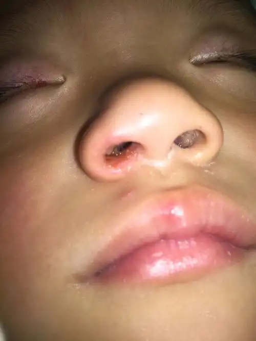 2岁半宝宝鼻孔里红肿的有脓血一样的东西!
