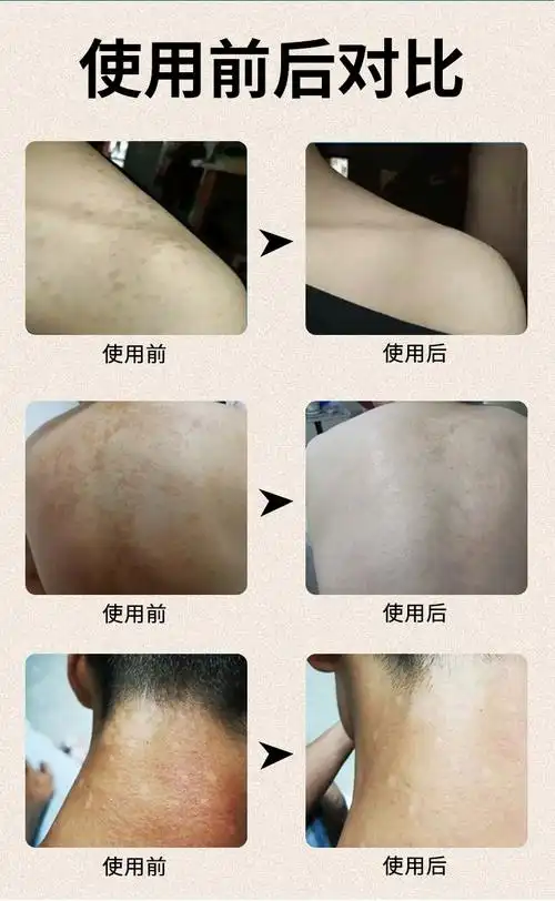 妙丹堂汗斑净 汗斑露 白斑花斑癣白癜风补骨脂止汗抑菌液