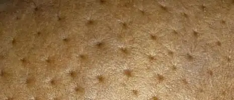 同心医关注乳腺健康远离乳腺癌