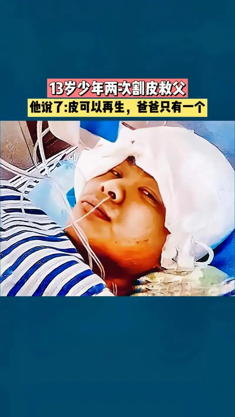 13岁荆楚少年王子豪,是一名初中的学生,他的爸爸大面积烧伤, - 抖音