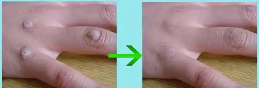 鱼鳞痣有什么症状_寻常疣病因_深圳新兴皮肤病专科