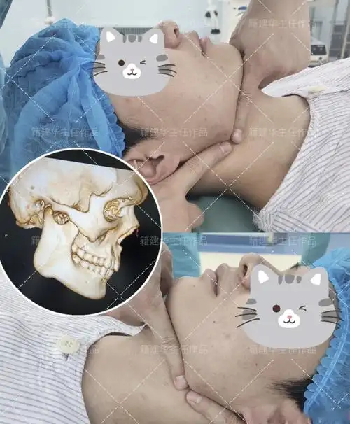 西安下颌角# 术后五个月反馈 案例中的小伙子下颌角形态非常典型