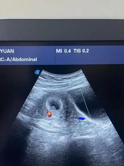 45天男孩胎囊图片