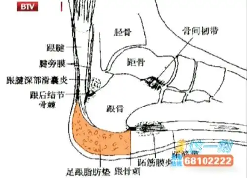 脚后跟痛真的有那么可怕吗跟痛症该如何预防缓解呢