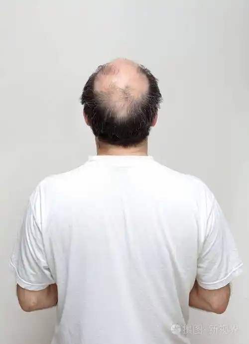 中年秃头男子脱发后视图