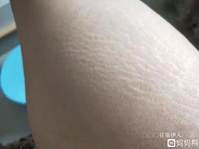 成熟!妊娠纹"淋漓尽致"-第1张图片-太白博客