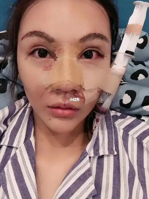 这才是恢复期_整容_双眼皮_美妆_医美整形