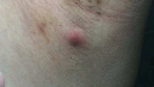 腋下鼓了个包?怎么回事?_淋巴结