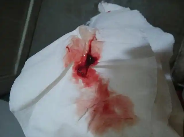 男人同房后下面出血了医生要警惕房事见红的问题