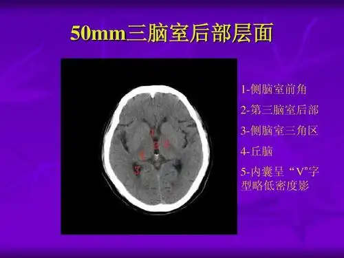 50mm三脑室后部层面 1-侧脑室前角 2-第三脑室后部 3-侧脑室三角区 4
