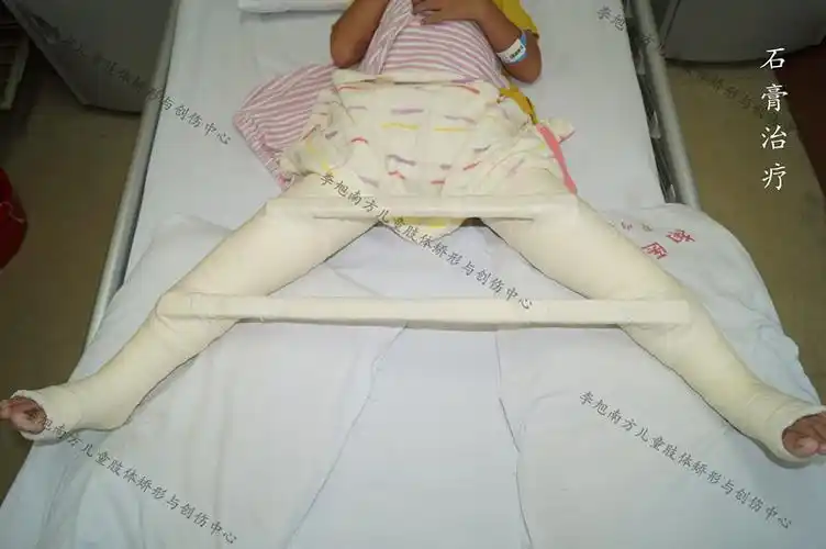 手术治疗主要适用于年龄大于6岁;有临床危象征(患髋有进行性,持久性的