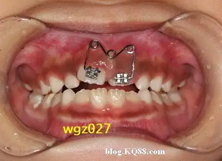 这个小女孩使用了三联别针簧矫治器原创